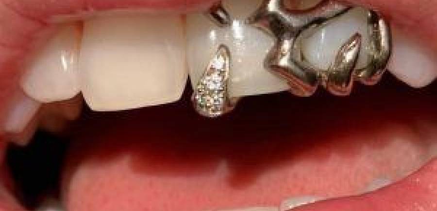 گریلز چیست؟ بررسی تاریخچه، مزایا و معایب گریلز